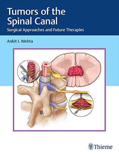 Tumors of the spinal canal :surgical approaches and future therapies /